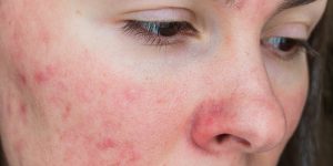 Haut - hilfreich bei Neurodermitis, Akne, Juckreiz Allergien